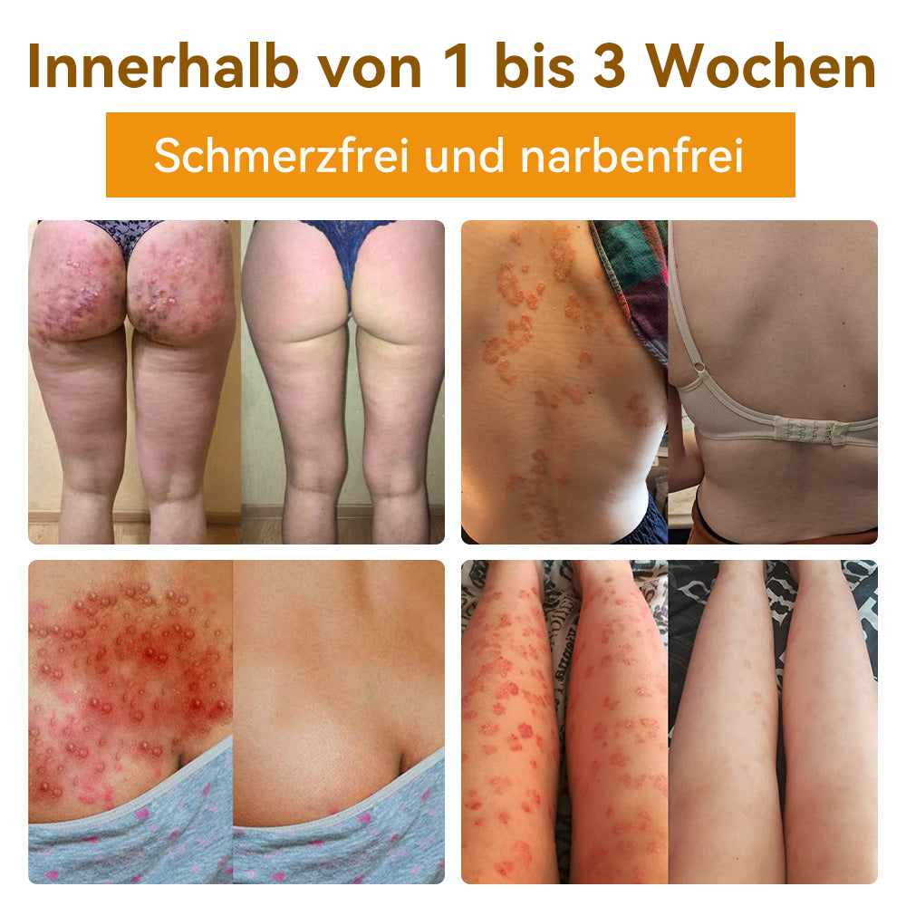 ✅[𝐎𝐟𝐟𝐢𝐳𝐢𝐞𝐥𝐥𝐞𝐫 𝐋𝐚𝐝𝐞𝐧]:5 Tage zu makelloser Haut 👍 𝑺𝑷𝒁𝑽™𝑩𝒊𝒆𝒏𝒆𝒏𝒈𝒊𝒇𝒕 𝑴𝒂𝒖𝒍𝒘𝒖𝒓𝒇 & 𝑾𝒂𝒓𝒛𝒆 𝑬𝒏𝒕𝒇𝒆𝒓𝒏𝒖𝒏𝒈 𝑪𝒓𝒆𝒎𝒆 (𝐄𝐧𝐣𝐨𝐲 𝟑𝟎% 𝐨𝐟𝐟 𝐧𝐨𝐰! 𝐋𝐢𝐦𝐢𝐭𝐞𝐝 𝐭𝐢𝐦𝐞 𝐨𝐟𝐟𝐞𝐫!)