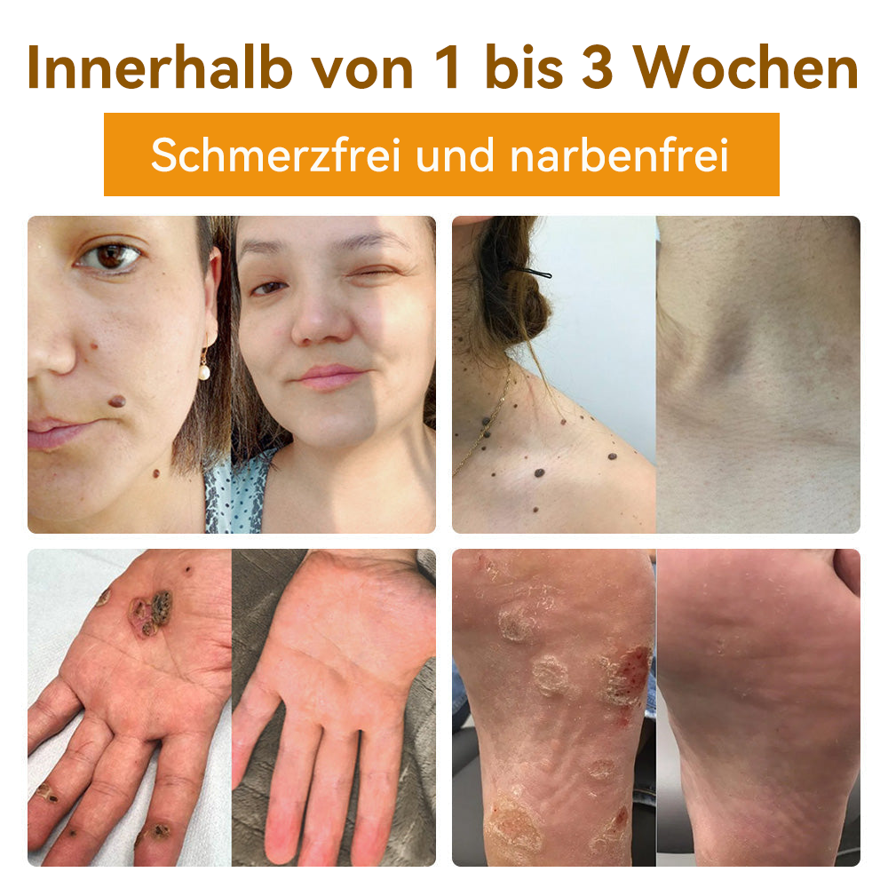 ✅[𝐎𝐟𝐟𝐢𝐳𝐢𝐞𝐥𝐥𝐞𝐫 𝐋𝐚𝐝𝐞𝐧]:5 Tage zu makelloser Haut 👍 𝑺𝑷𝒁𝑽™𝑩𝒊𝒆𝒏𝒆𝒏𝒈𝒊𝒇𝒕 𝑴𝒂𝒖𝒍𝒘𝒖𝒓𝒇 & 𝑾𝒂𝒓𝒛𝒆 𝑬𝒏𝒕𝒇𝒆𝒓𝒏𝒖𝒏𝒈 𝑪𝒓𝒆𝒎𝒆 (𝐄𝐧𝐣𝐨𝐲 𝟑𝟎% 𝐨𝐟𝐟 𝐧𝐨𝐰! 𝐋𝐢𝐦𝐢𝐭𝐞𝐝 𝐭𝐢𝐦𝐞 𝐨𝐟𝐟𝐞𝐫!)