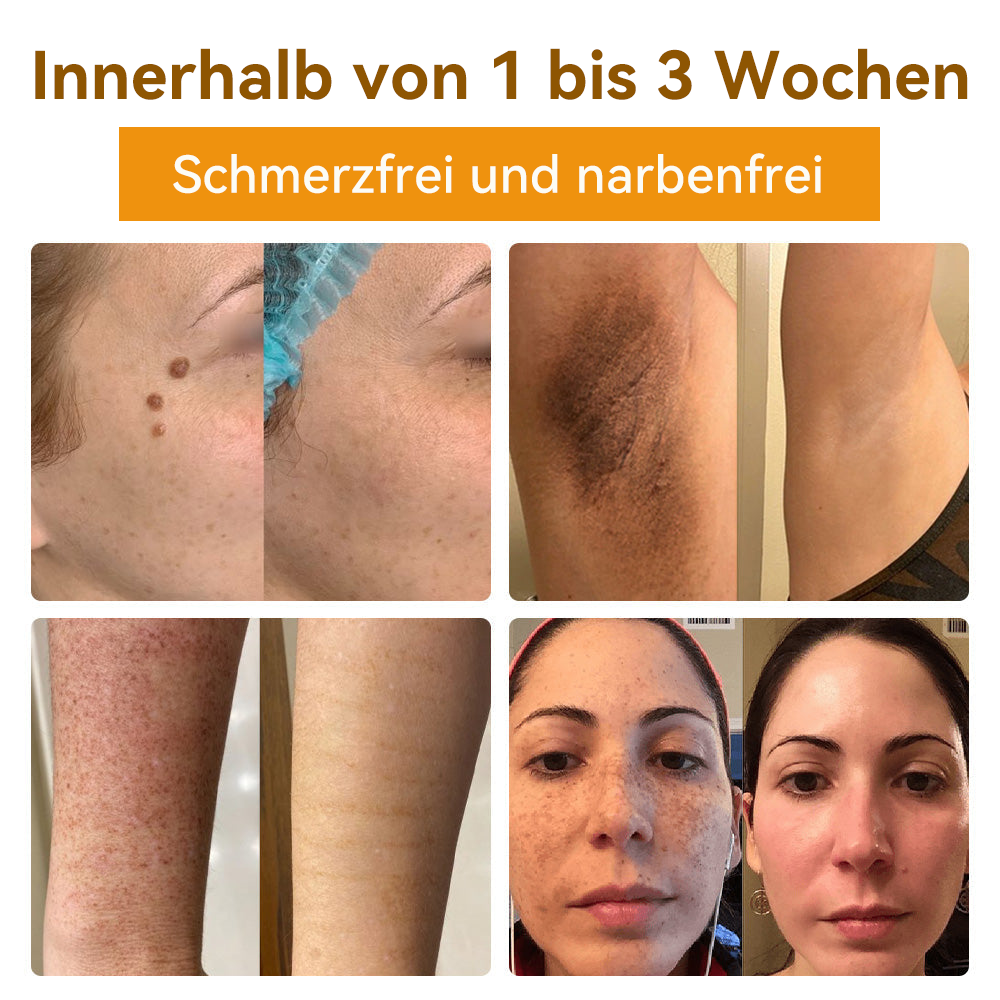 ✅[𝐎𝐟𝐟𝐢𝐳𝐢𝐞𝐥𝐥𝐞𝐫 𝐋𝐚𝐝𝐞𝐧]:5 Tage zu makelloser Haut 👍 𝑺𝑷𝒁𝑽™𝑩𝒊𝒆𝒏𝒆𝒏𝒈𝒊𝒇𝒕 𝑴𝒂𝒖𝒍𝒘𝒖𝒓𝒇 & 𝑾𝒂𝒓𝒛𝒆 𝑬𝒏𝒕𝒇𝒆𝒓𝒏𝒖𝒏𝒈 𝑪𝒓𝒆𝒎𝒆 (𝐄𝐧𝐣𝐨𝐲 𝟑𝟎% 𝐨𝐟𝐟 𝐧𝐨𝐰! 𝐋𝐢𝐦𝐢𝐭𝐞𝐝 𝐭𝐢𝐦𝐞 𝐨𝐟𝐟𝐞𝐫!)